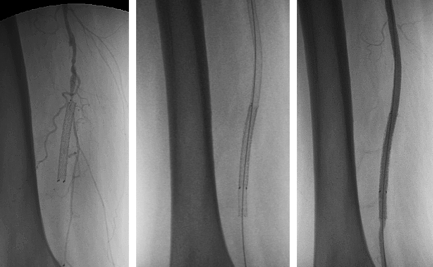 Figure 4; Endovascular Procedure